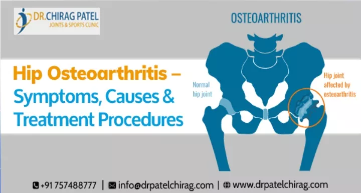 Ppt Hip Osteoarthritis Symptoms Causes Treatment Procedures Dr Chirag Patel Powerpoint