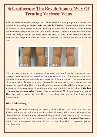 sclerotherapy the revolutionary way of treating