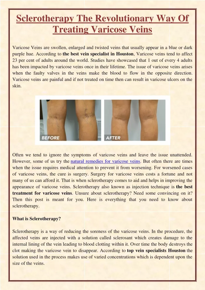 sclerotherapy the revolutionary way of treating