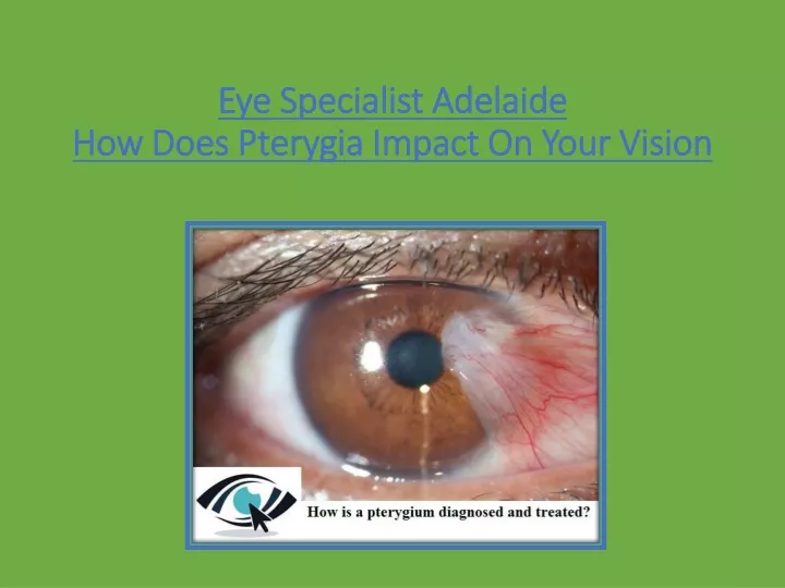 eye specialist adelaide how does pterygia impact on your vision