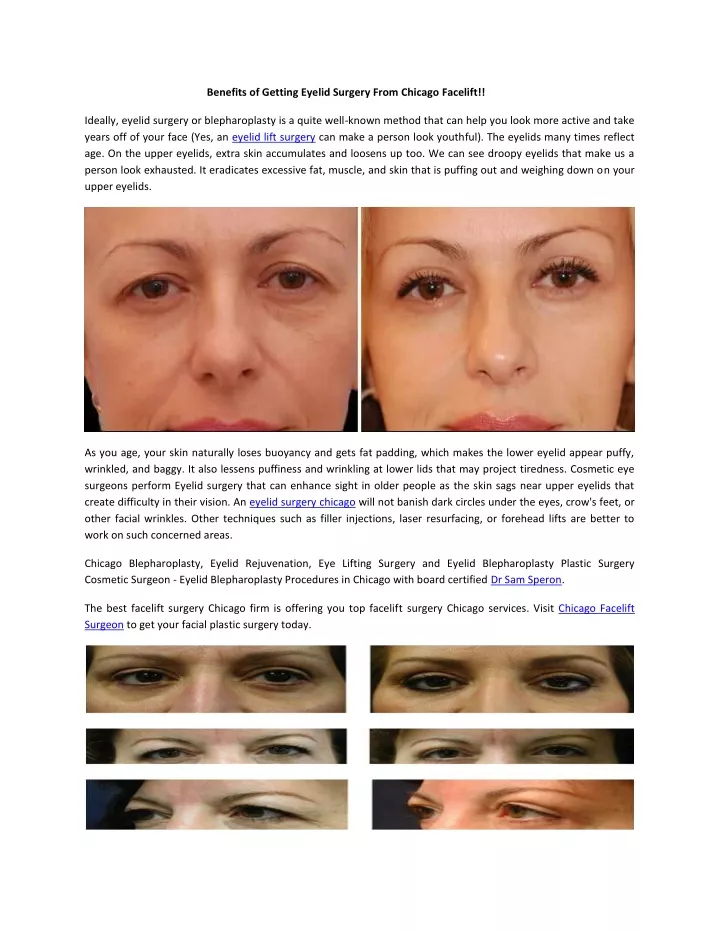 benefits of getting eyelid surgery from chicago