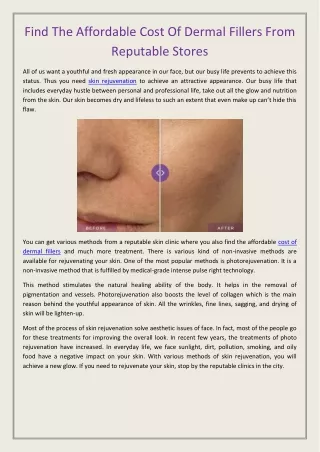 find the affordable cost of dermal fillers from