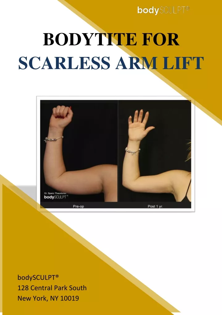 bodytite for scarless arm lift