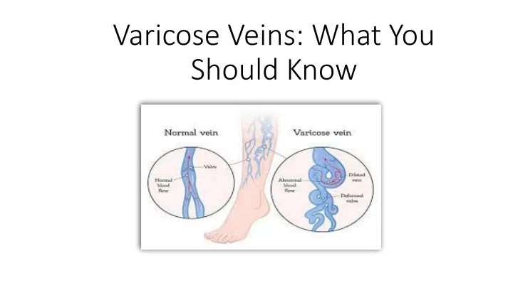 varicose veins what you should know