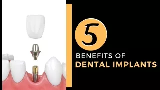 5 Benefits of Dental Implants