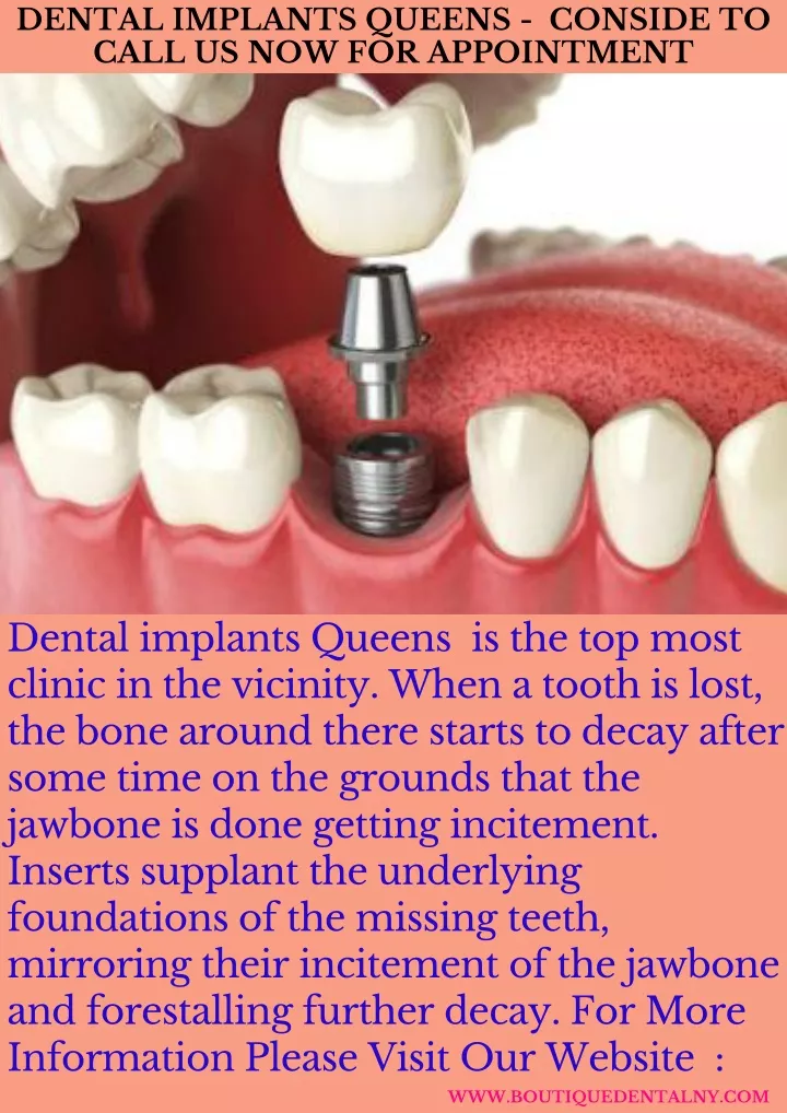 dental implants queens conside to call