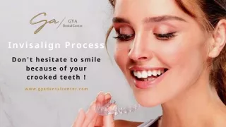 Invisalign Process, Benefits, and Procedure