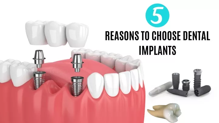 reasons to choose dental implants