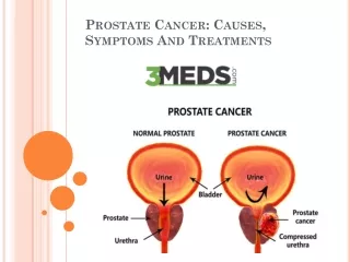 What is Prostate Cancer: Causes, Symptoms And Treatments