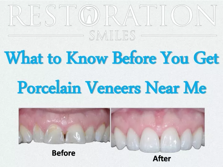 what to know before you get porcelain veneers near me