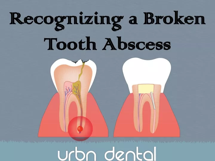 recognizing a broken tooth abscess