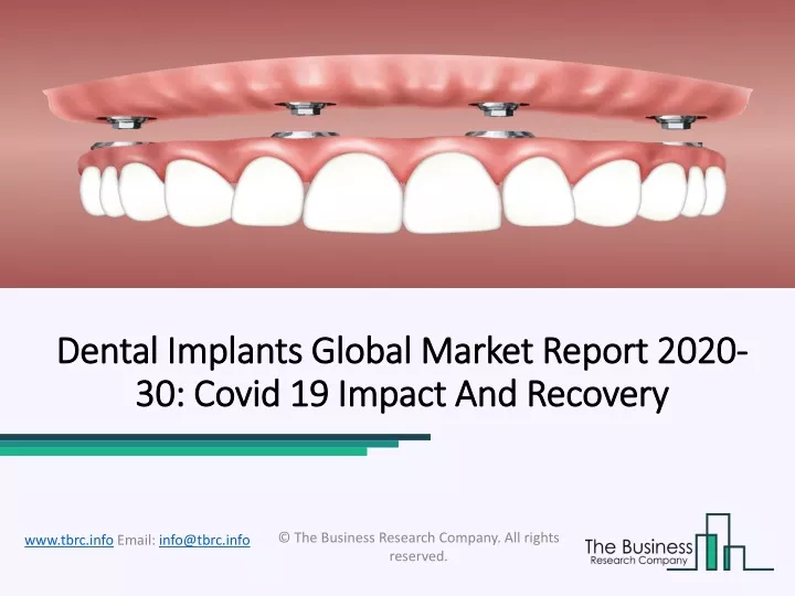 dental implants dental implants global