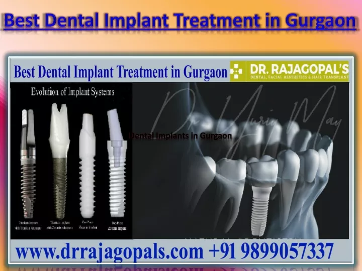 best dental implant treatment in gurgaon