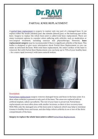 PARTIAL KNEE REPLACEMENT SURGEON IN AHMEDABAD