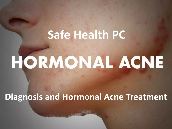 diagnosis and hormonal acne treatment