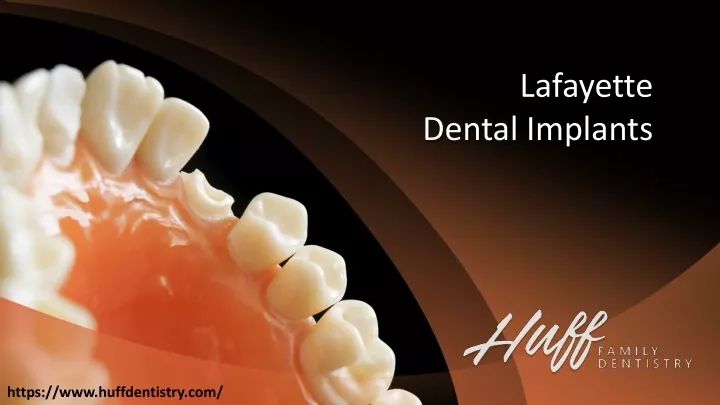 lafayette dental implants