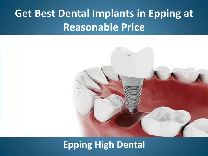 get best dental implants in epping at reasonable price