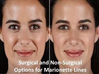 Surgical and non surgical options for marionette lines