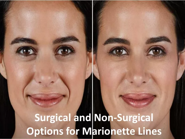 surgical and non surgical options for marionette lines