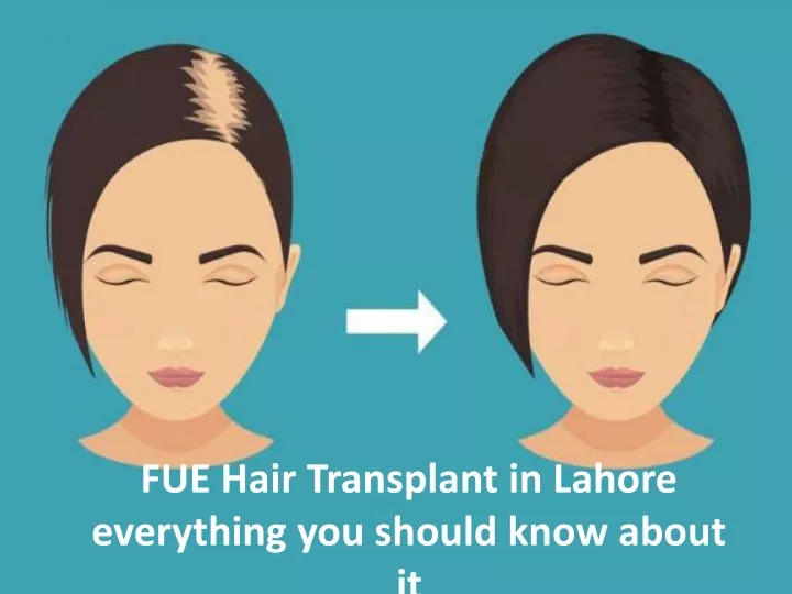 fue hair transplant in lahore everything you should know about it