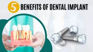 5 Benefits of Dental Implant