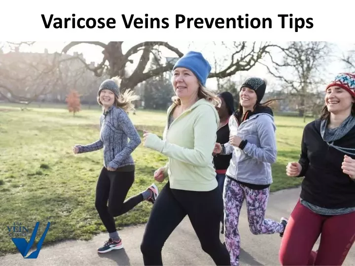 varicose veins prevention tips