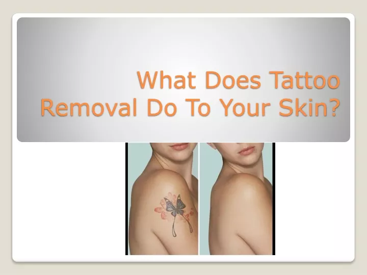what does tattoo removal do to your skin