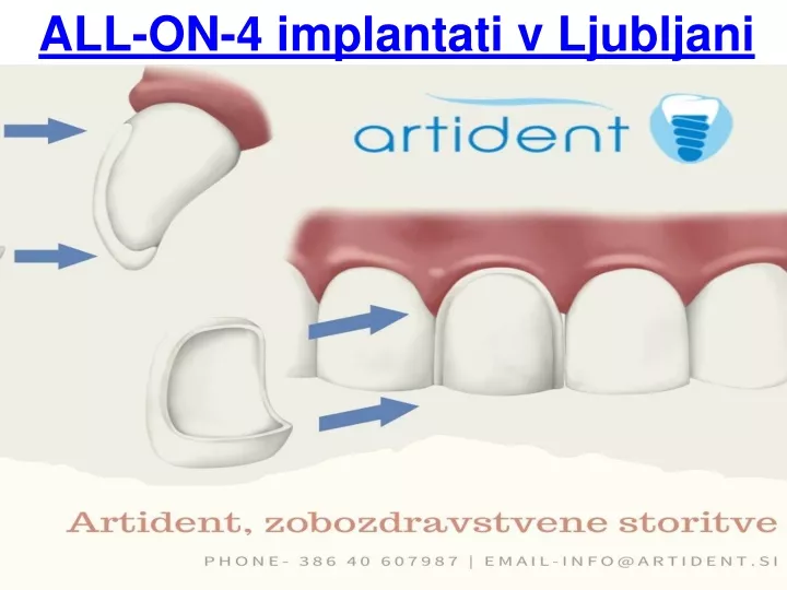 all on 4 implantati v ljubljani