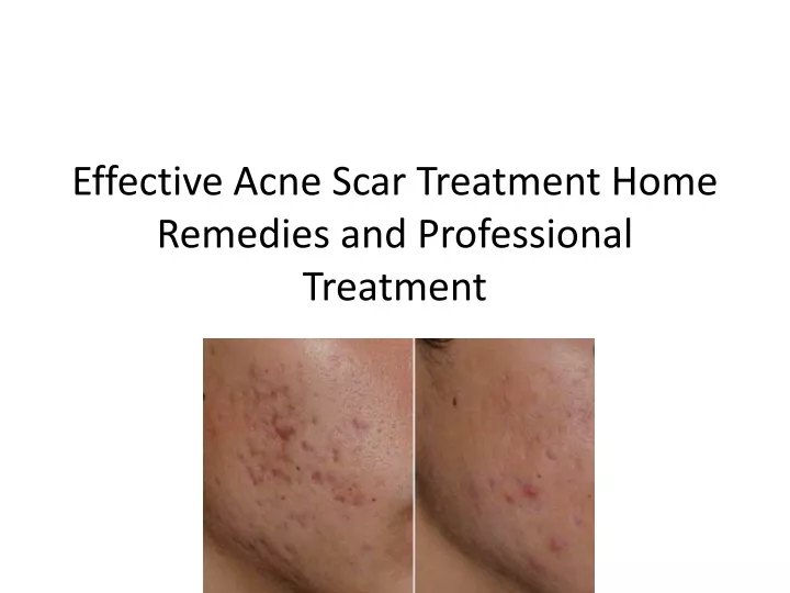 effective acne scar treatment home remedies and professional treatment