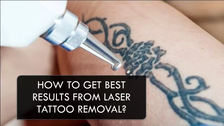 how to get best results from laser tattoo removal