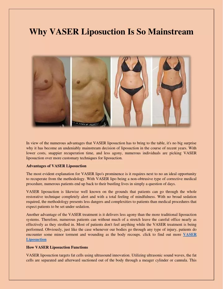 why vaser liposuction is so mainstream