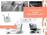 DIGITAL ROOT CANAL TREATMENT (RCT)