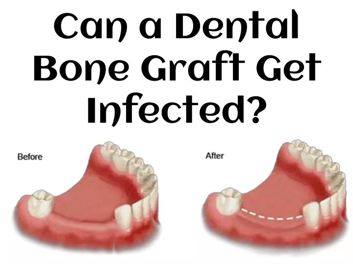can a dental bone graft get infected