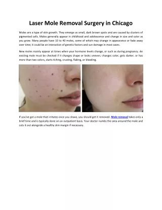 Laser Mole Removal Surgery in Chicago