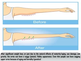 Arm lift surgery facts you should know!