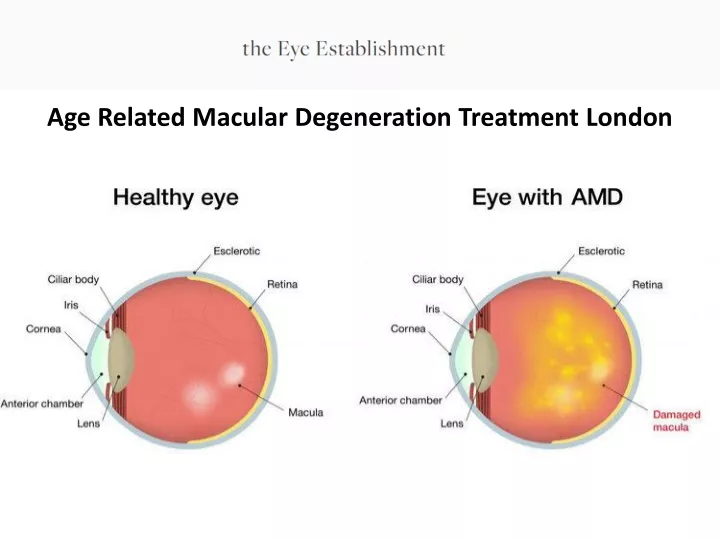 age related macular degeneration treatment london