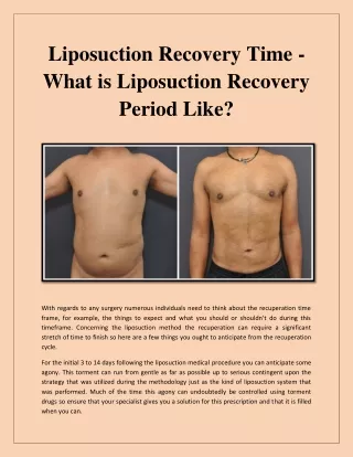 liposuction