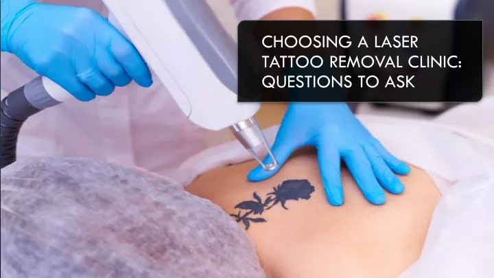 choosing a laser tattoo removal clinic questions to ask