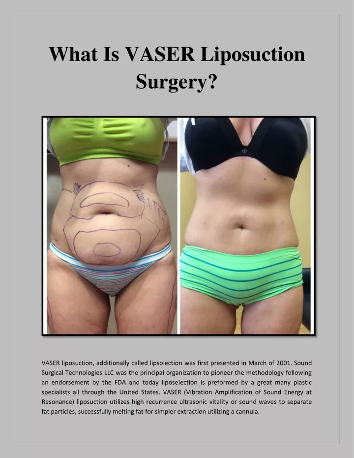 what is vaser liposuction surgery