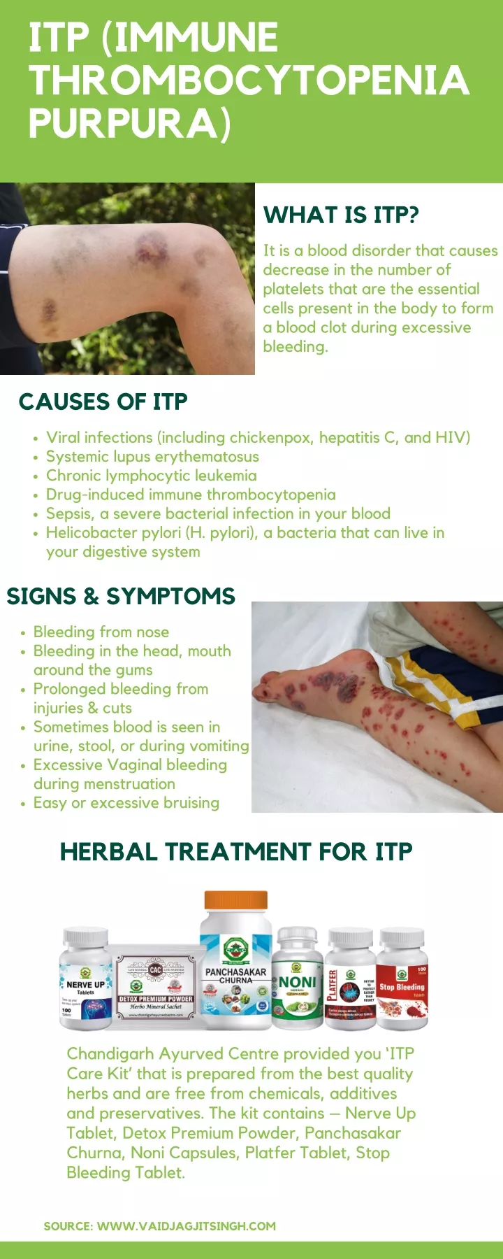 itp immune thrombocytopenia purpura