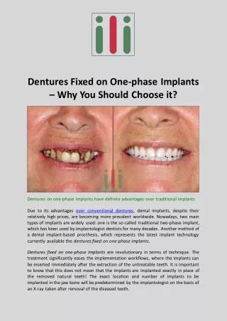 Dentures Fixed on One-phase Implants - Why You Should Choose it?
