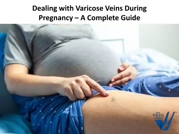 dealing with varicose veins during pregnancy a complete guide