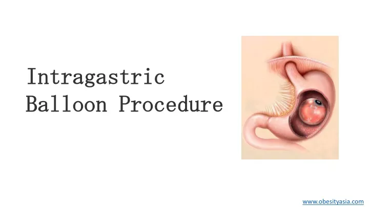 intragastric balloon procedure