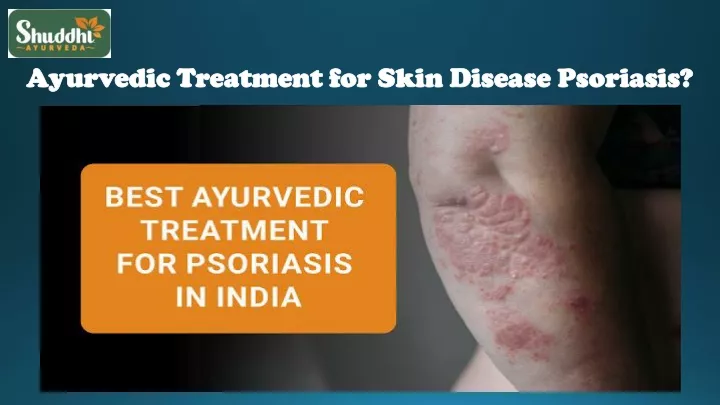 ayurvedic treatment for skin disease psoriasis