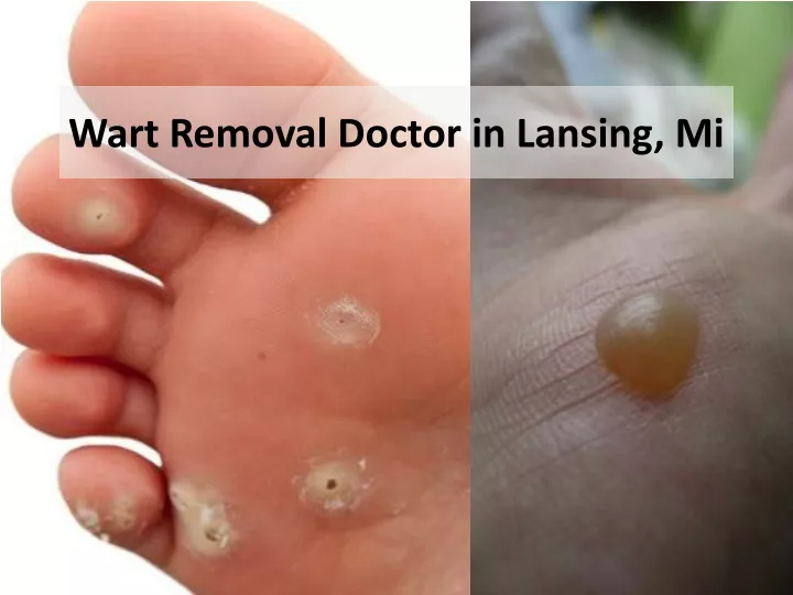 wart removal doctor in lansing mi