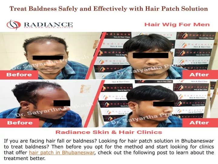 treat baldness safely and effectively with hair