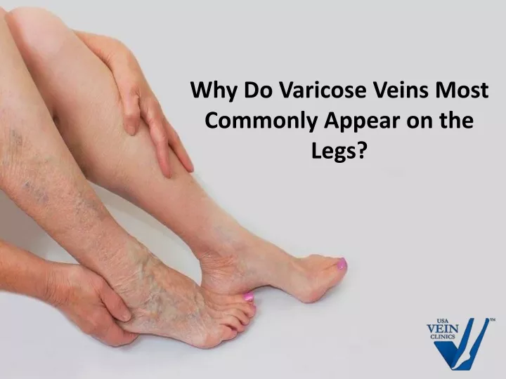 why do varicose veins most commonly appear