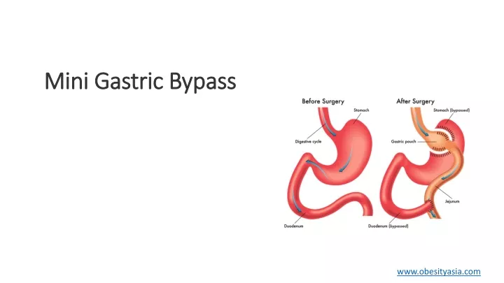 mini gastric bypass mini gastric bypass