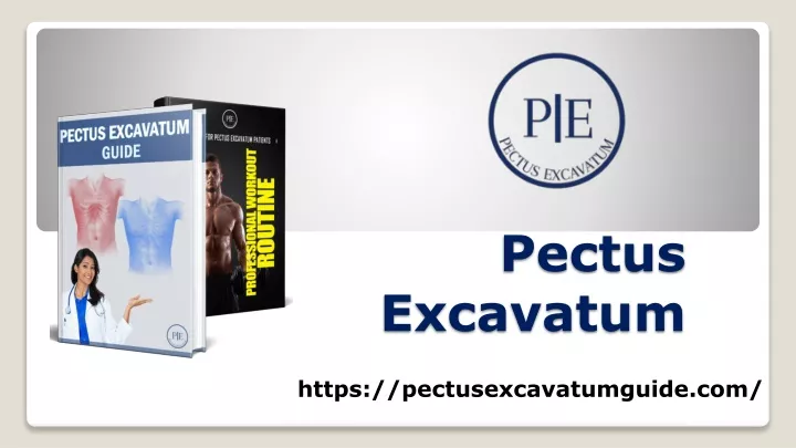 pectus excavatum