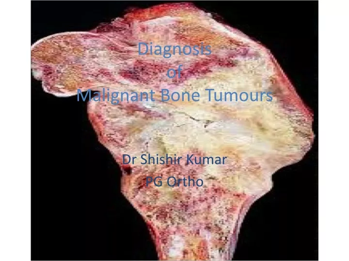 diagnosis of malignant bone tumours